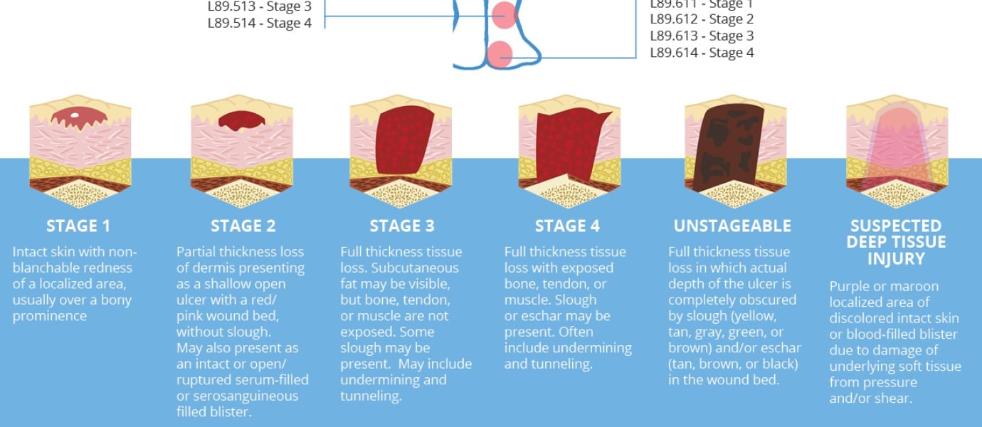 Skin Ulcer Stages